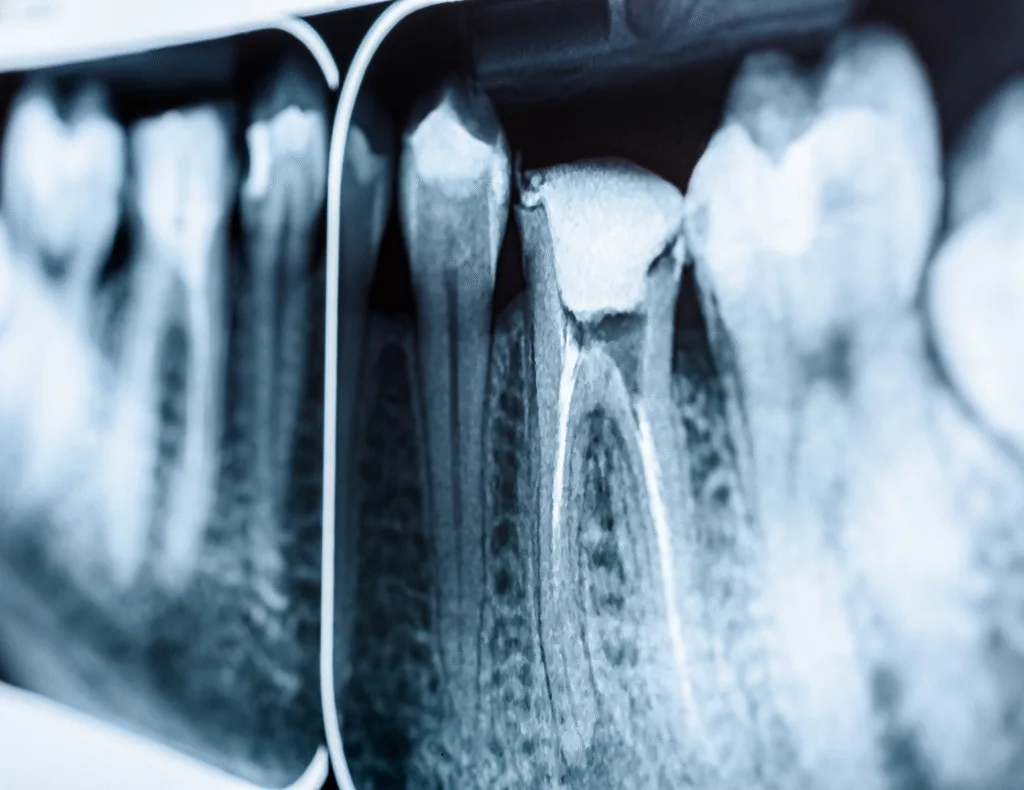 Endodoncia-y-cirugia-monte-grande