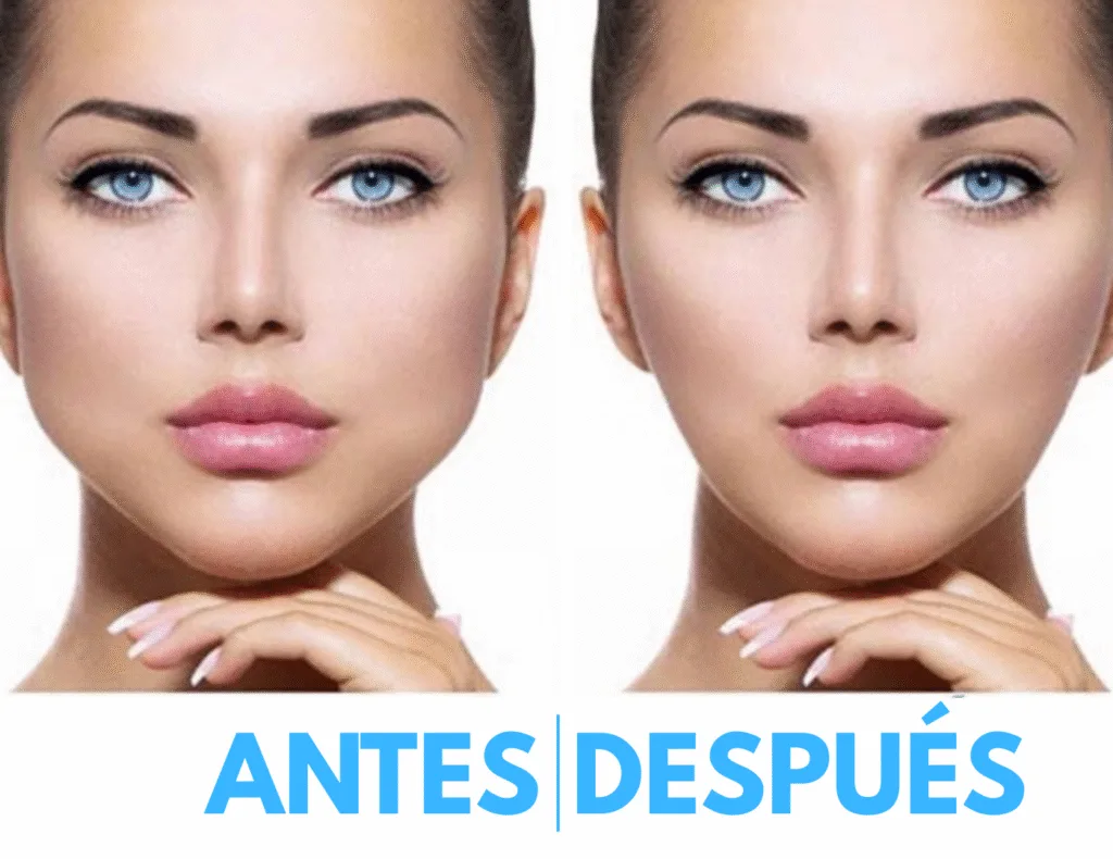 Bichectomía-en-monte-grande